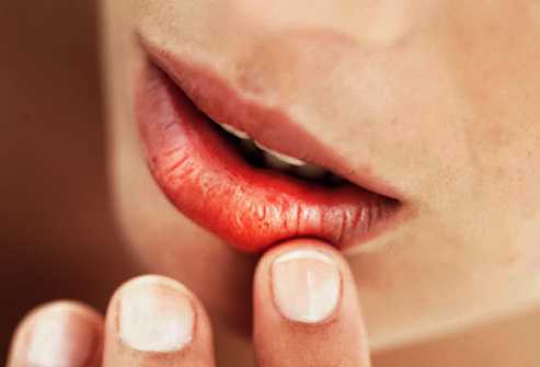 Почему трескаются губы Трещины в уголках губ